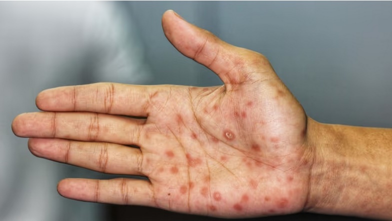 BAJA DISTRIBUCI&Oacute;N DE PRESERVATIVOS Y AUMENTO DE CASOS DE S&Iacute;FILIS, UN COMBO LETAL EN SALUD SEXUAL